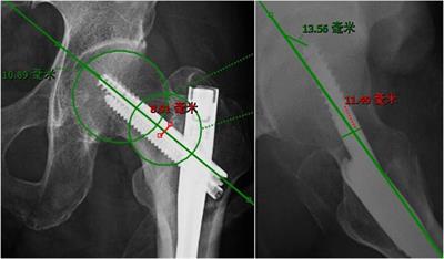 Key factors for increased tip-apex distance when treating intertrochanteric fractures with InterTAN nails